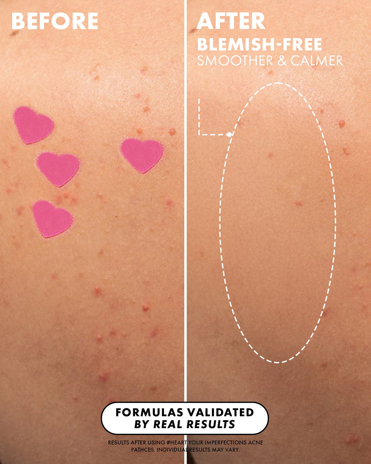 #Heart Your Imperfections Blemish Patches