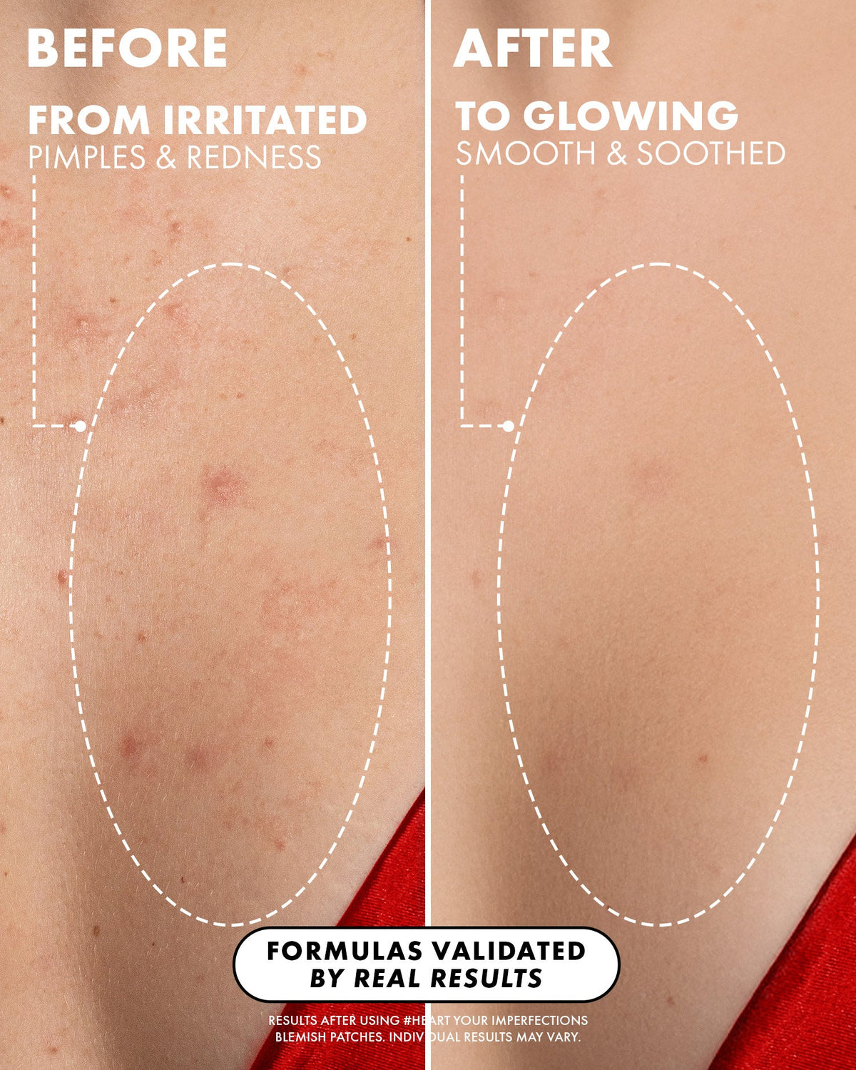 #Heart Your Imperfections Blemish Patches